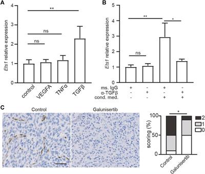 Uncovering a Key Role of ETS1 on Vascular Abnormality in Glioblastoma